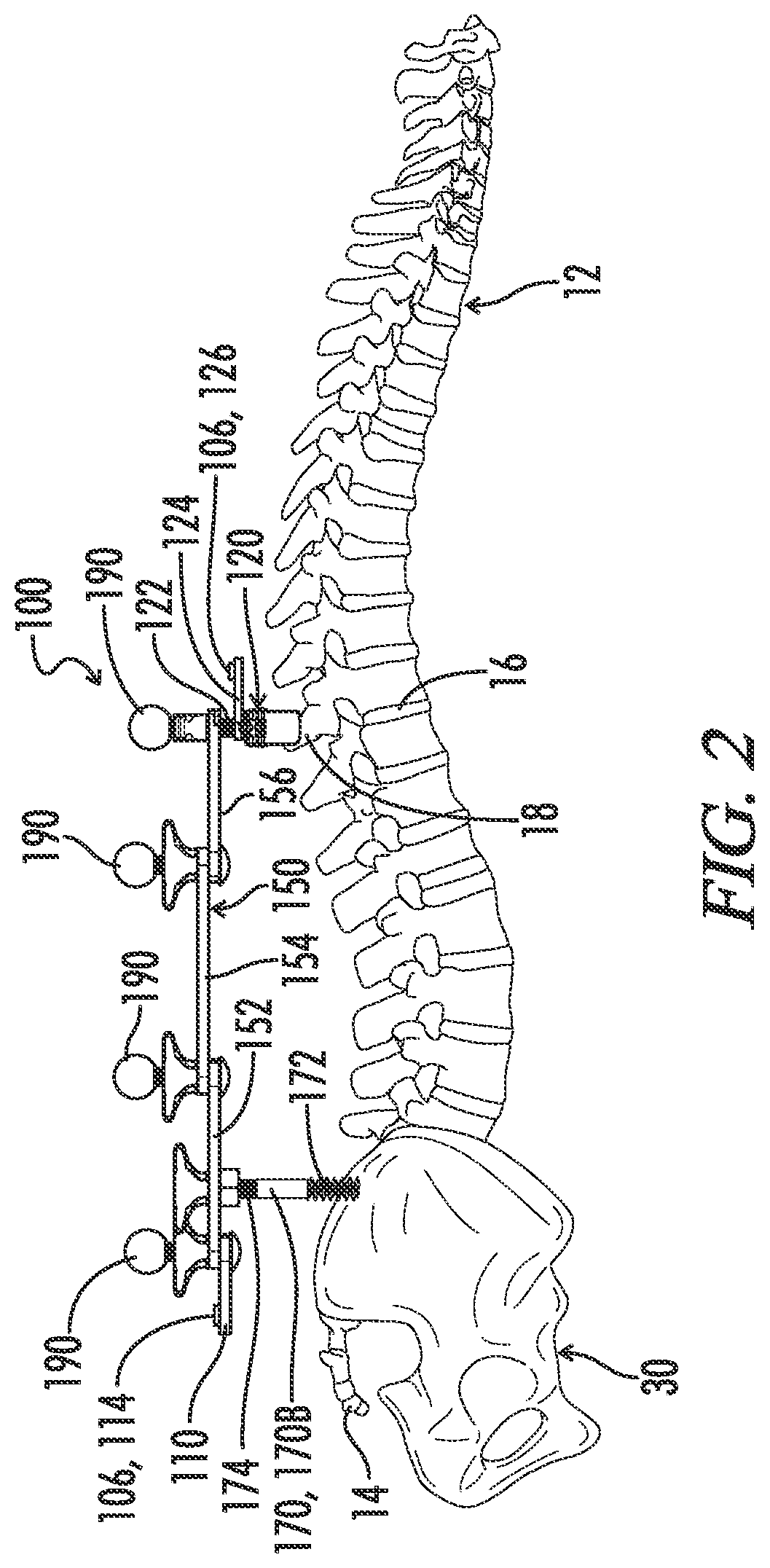 Spinal stabilization apparatus for the detection and prevention of a loss of robotic accuracy and method thereof