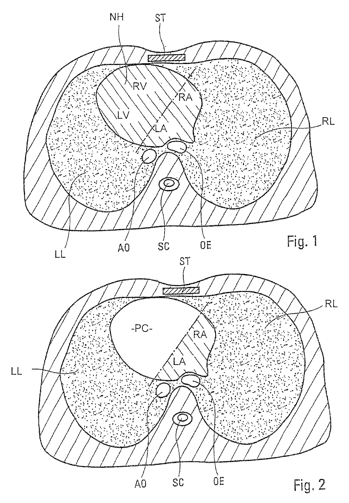 One-piece heart prosthesis implantable in an anatomical position