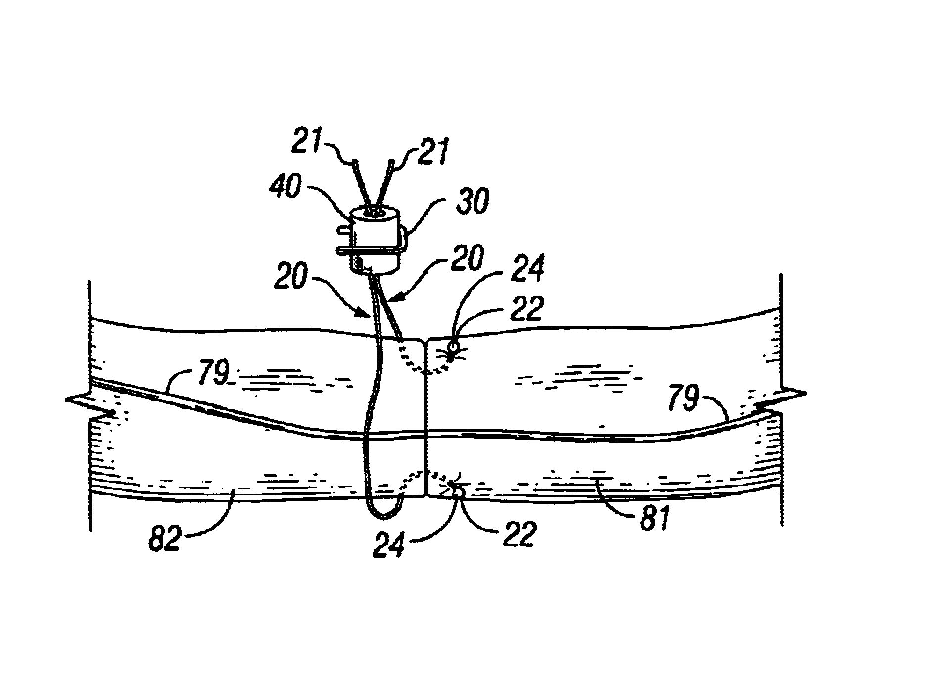 Surgical system for repairing and grafting severed nerves and methods of repairing and grafting severed nerves