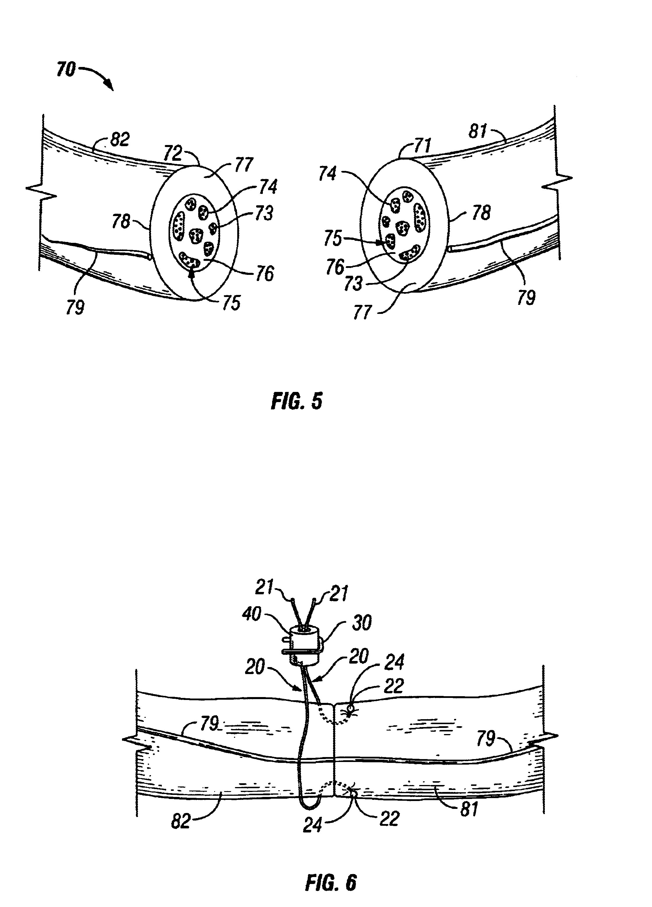 Surgical system for repairing and grafting severed nerves and methods of repairing and grafting severed nerves