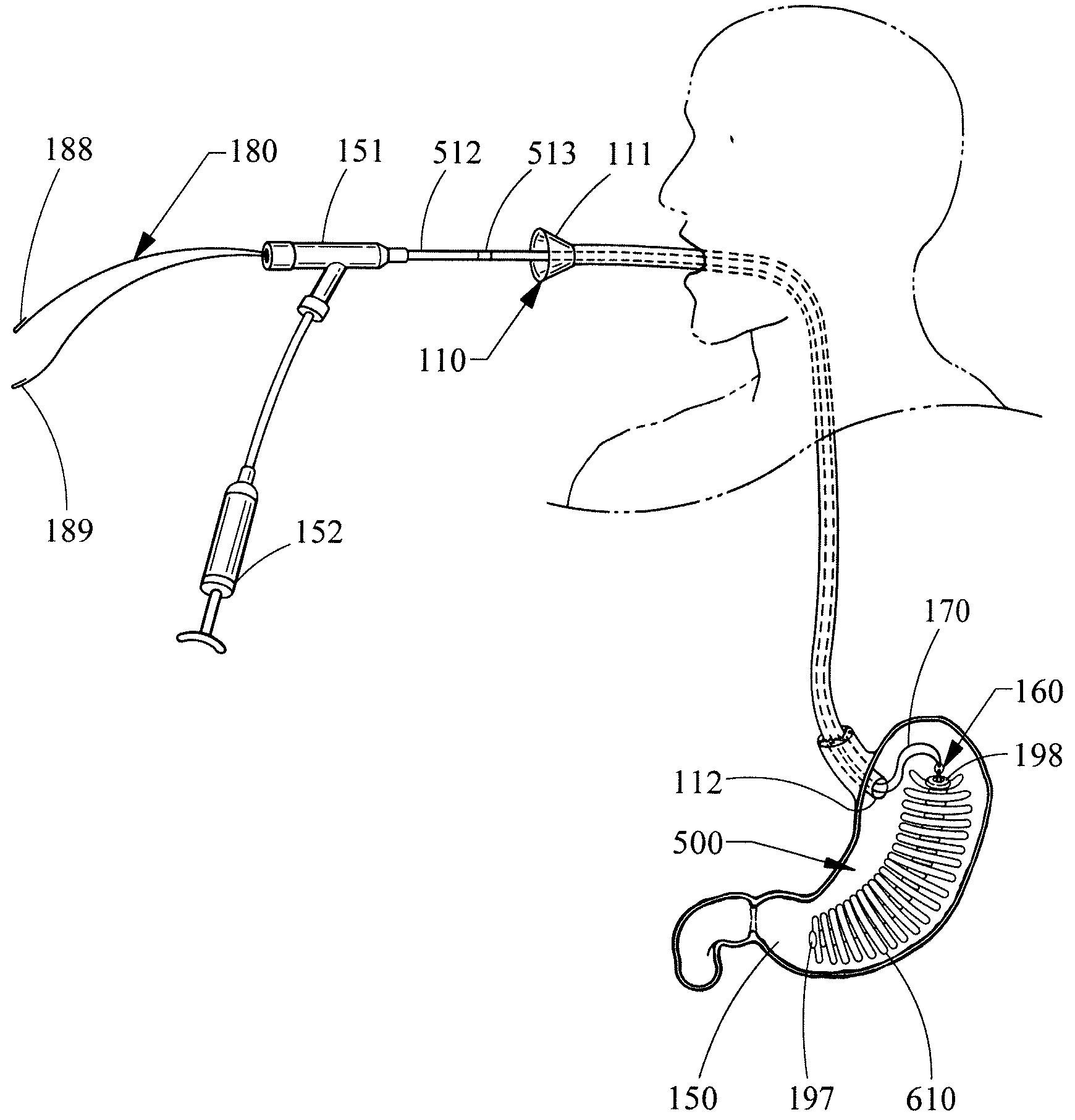 Delivery system and method of delivery for treating obesity