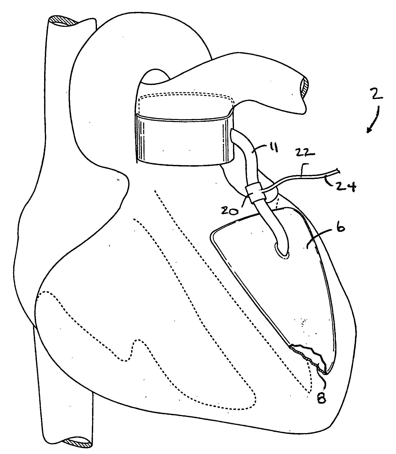 Devices and methods for absorbing, transferring, and delivering heart energy