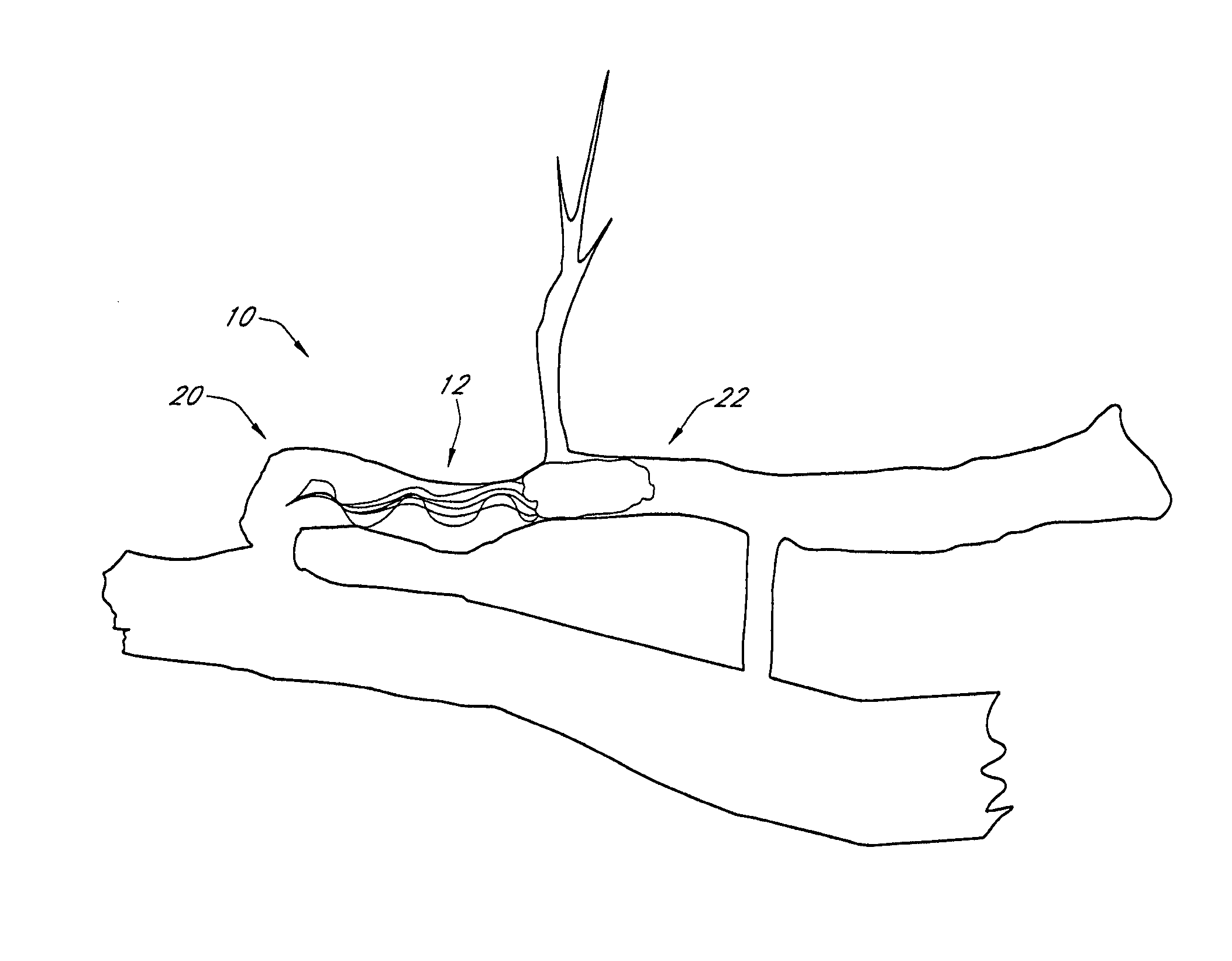 Occlusive implant and methods for hollow anatomical structure