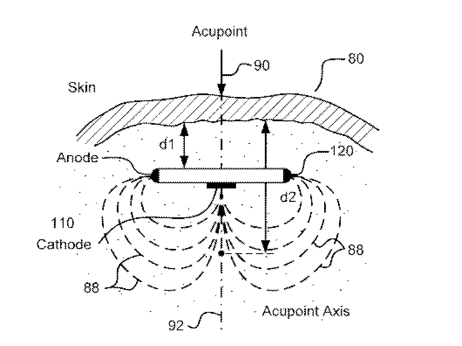 Circuits and Methods for Using a High Impedance, Thin, Coin-Cell Type Battery in an Implantable Electroacupuncture Device