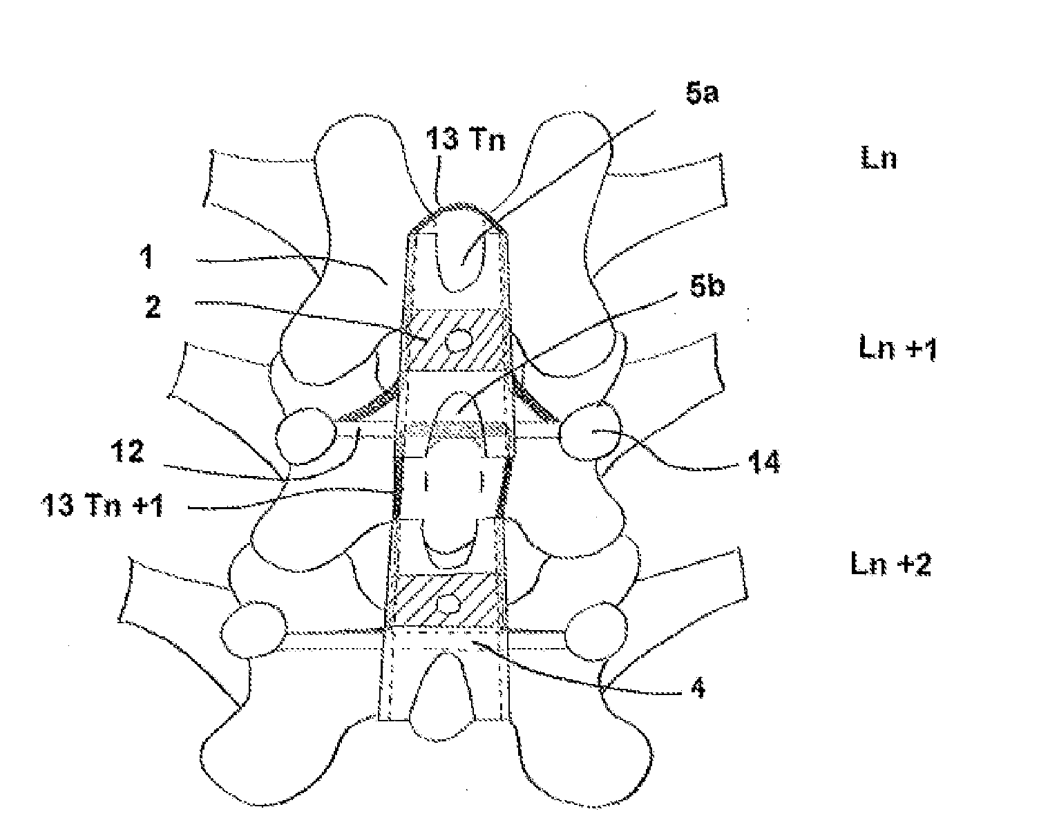 Intervertebral dynamic fixation implant