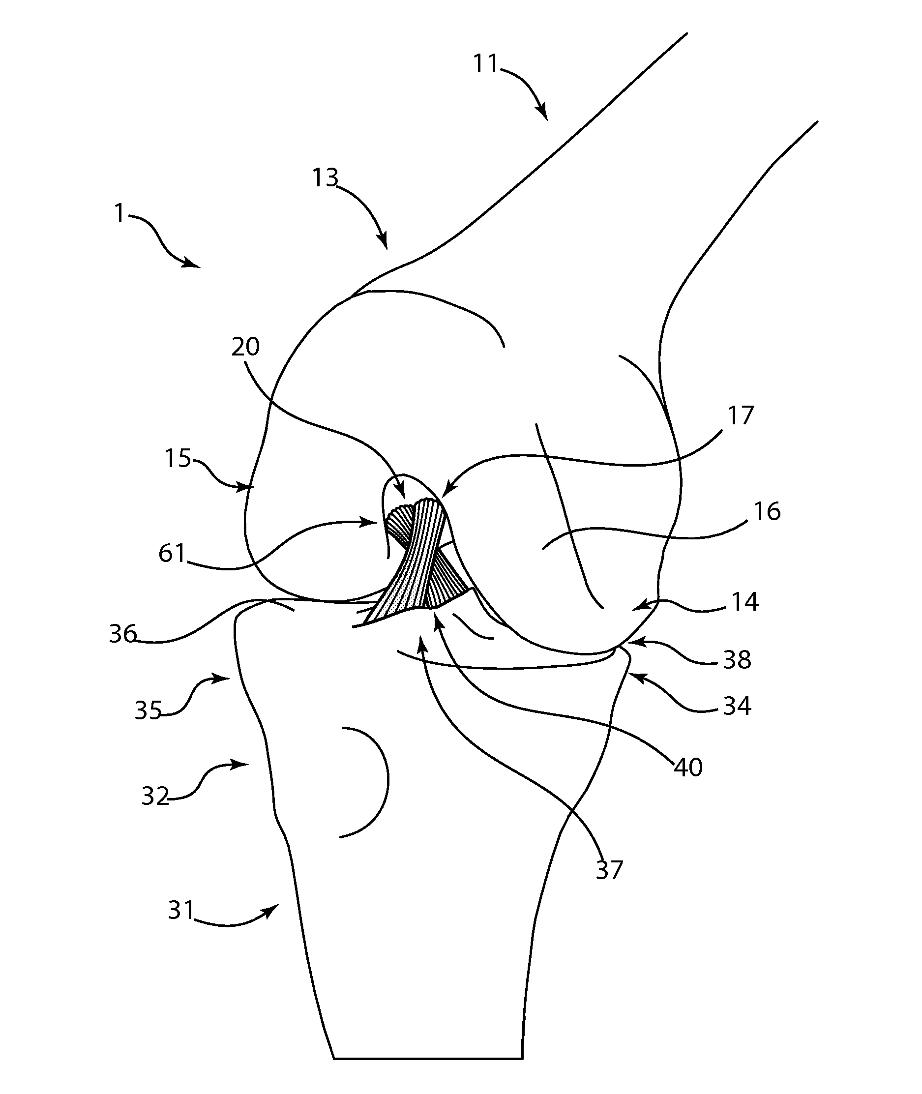 Double bundle acl repair system