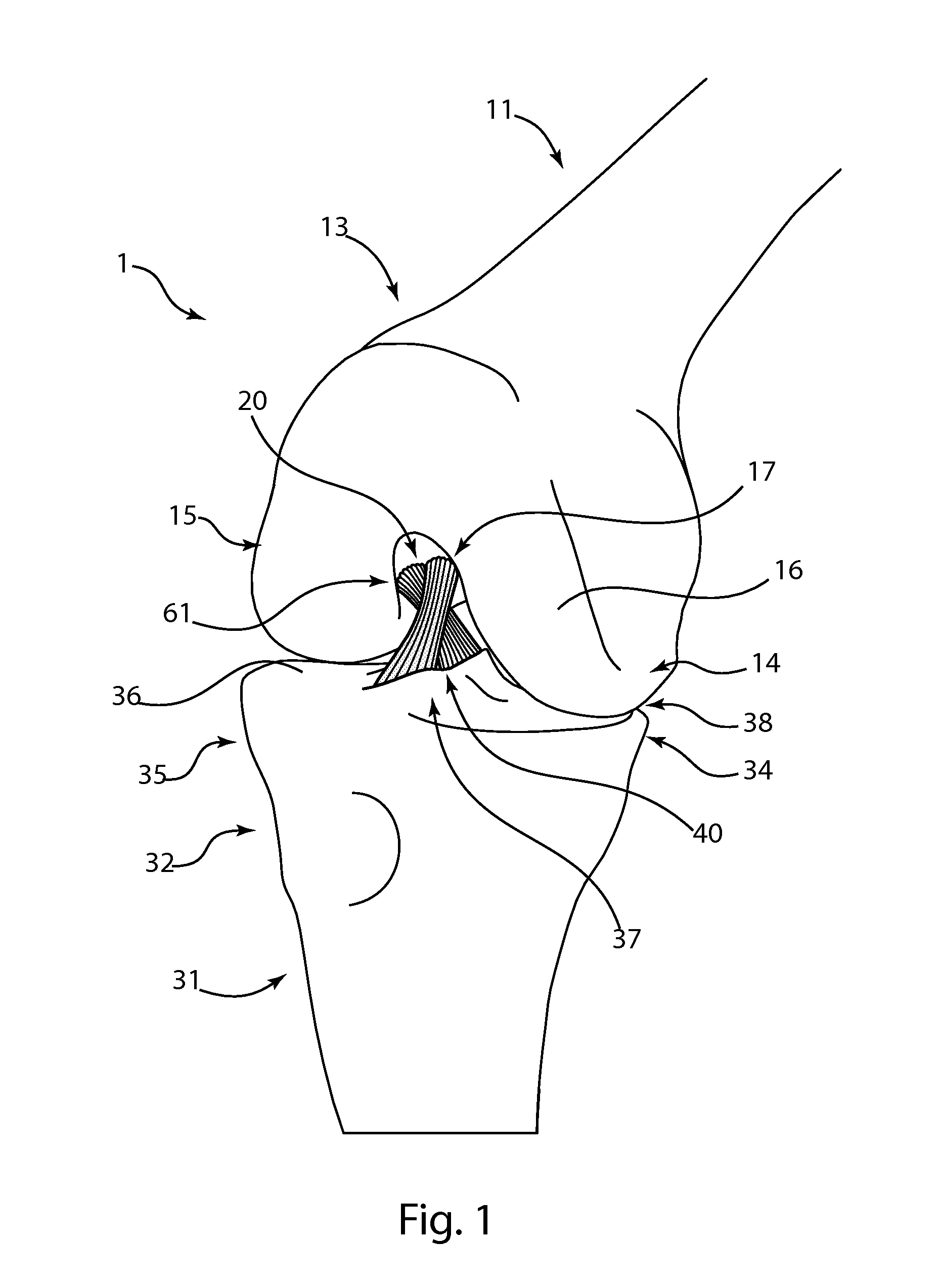 Double bundle acl repair system