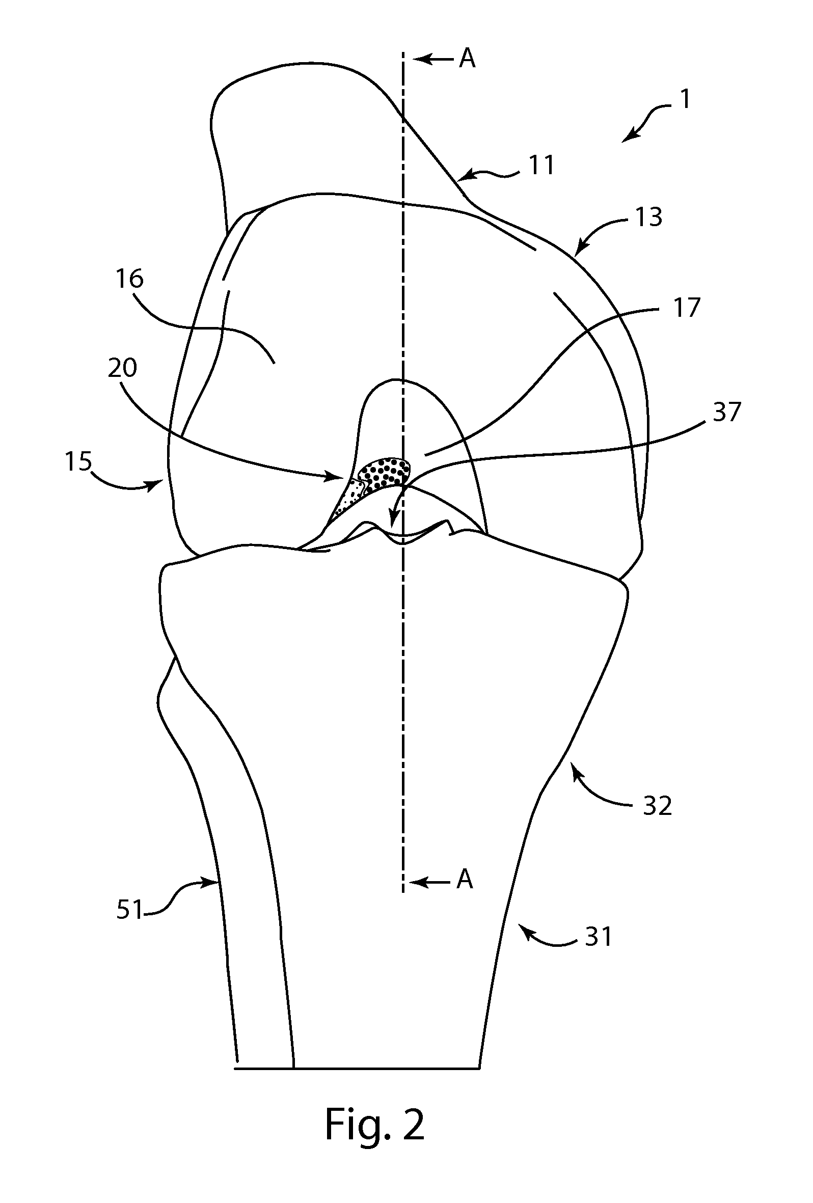 Double bundle acl repair system