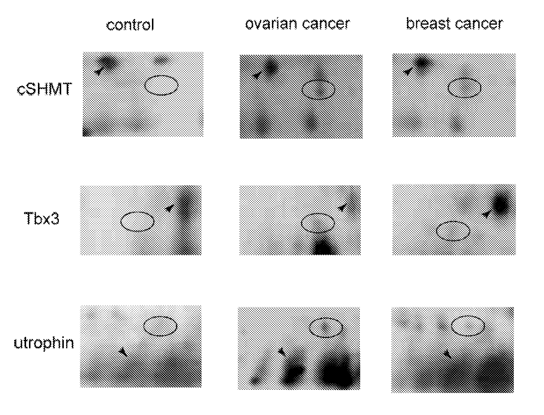 Protein markers for the diagnosis and prognosis of ovarian and breast cancer