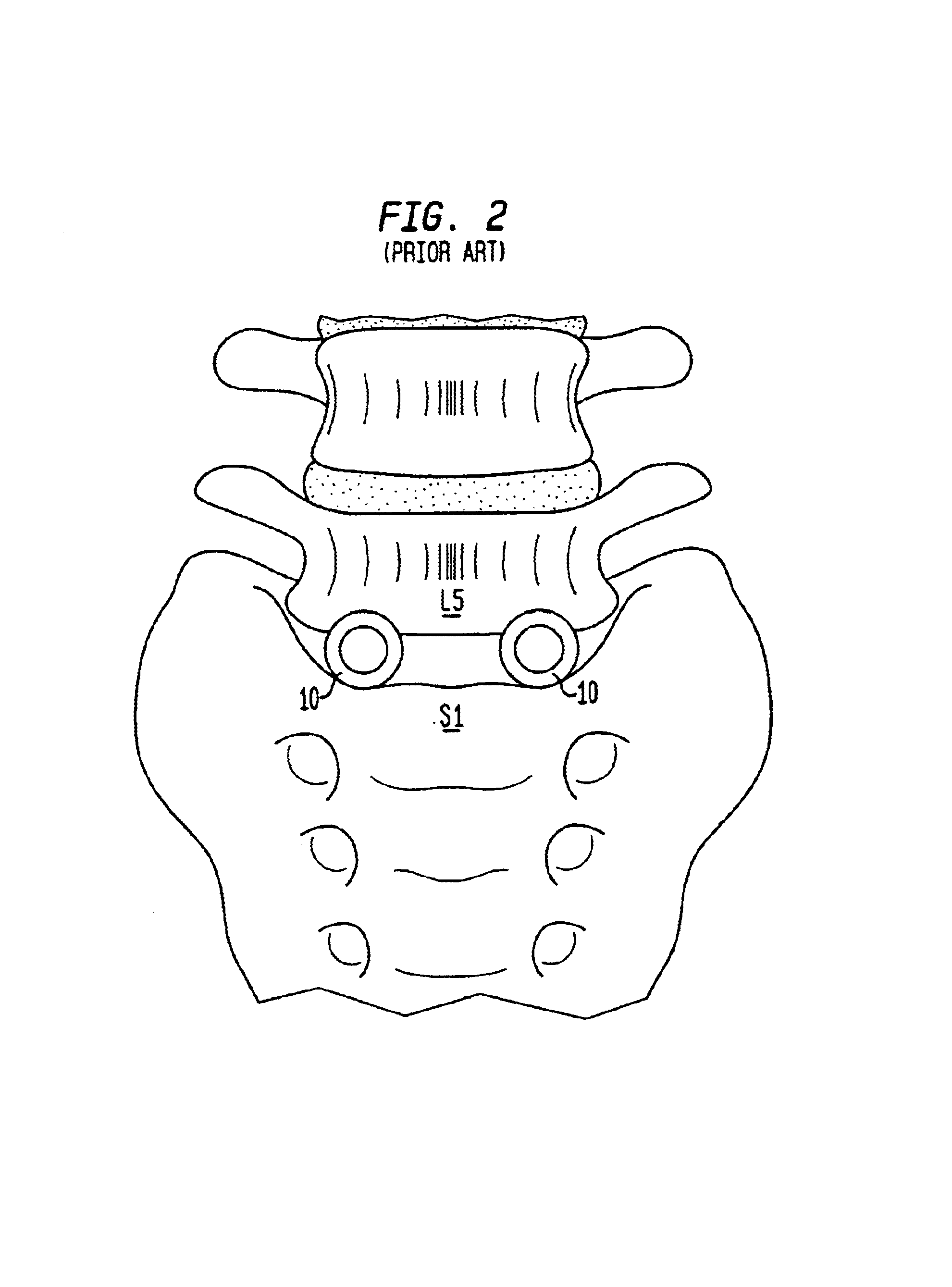 Intervertebral spacer device utilizing a spirally slotted belleville washer having radially spaced concentric grooves