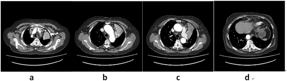 Automatic extraction method of human chest organ tissue