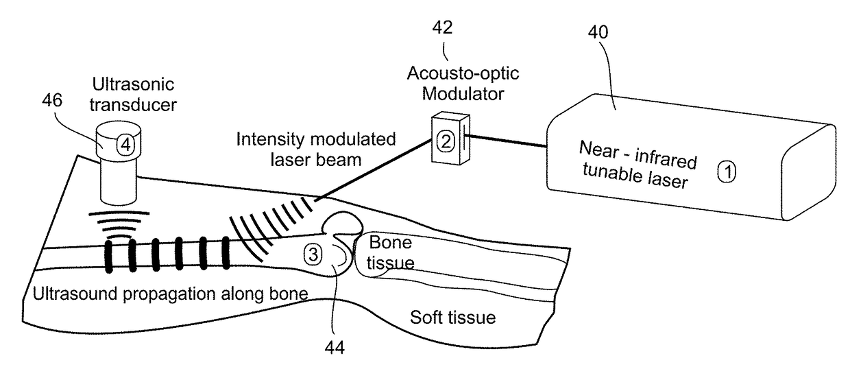 Detection, diagnosis and monitoring of osteoporosis by a photo-acoustic method