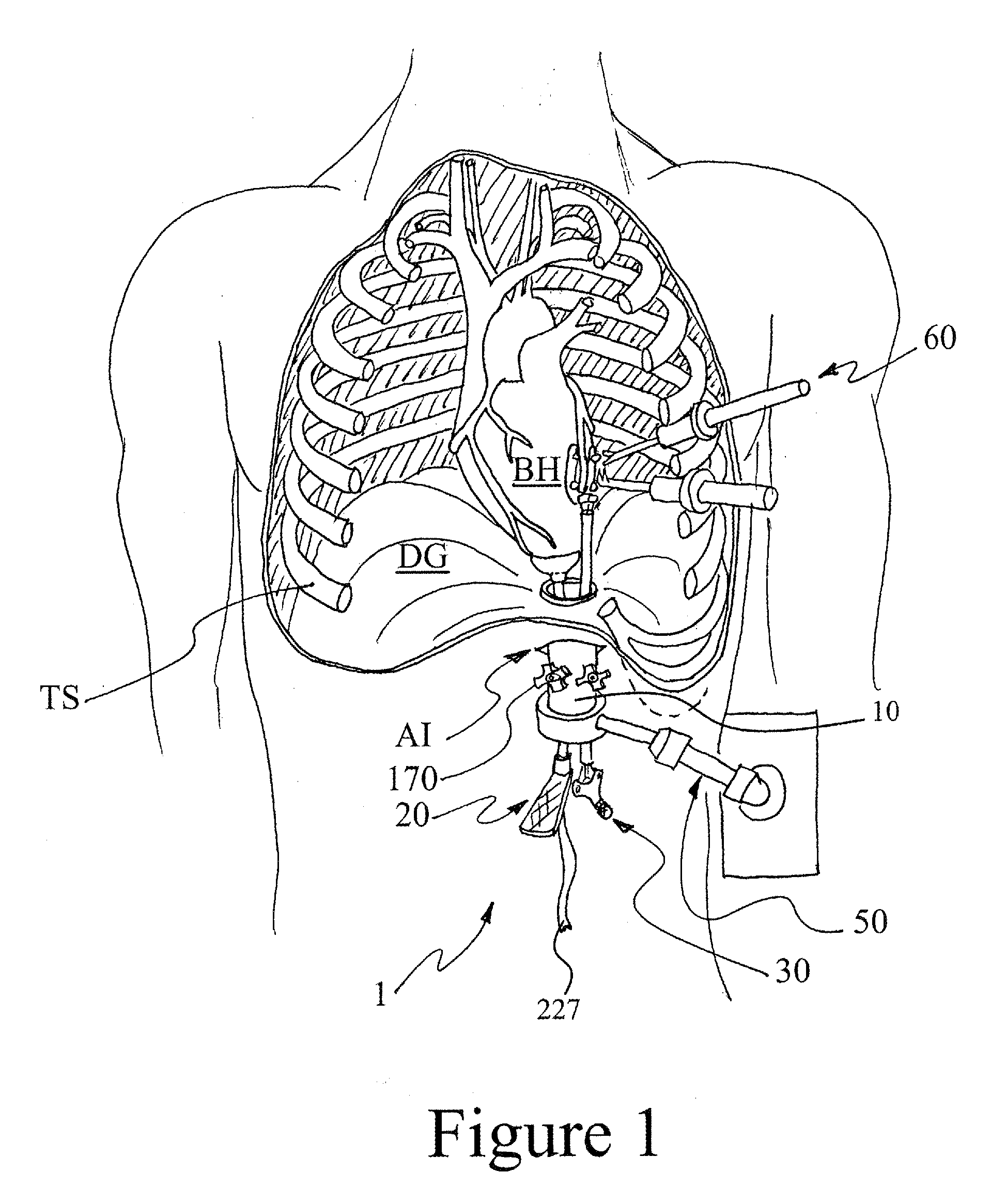 Surgical apparatus and method for performing transabdominal cardiac surgery