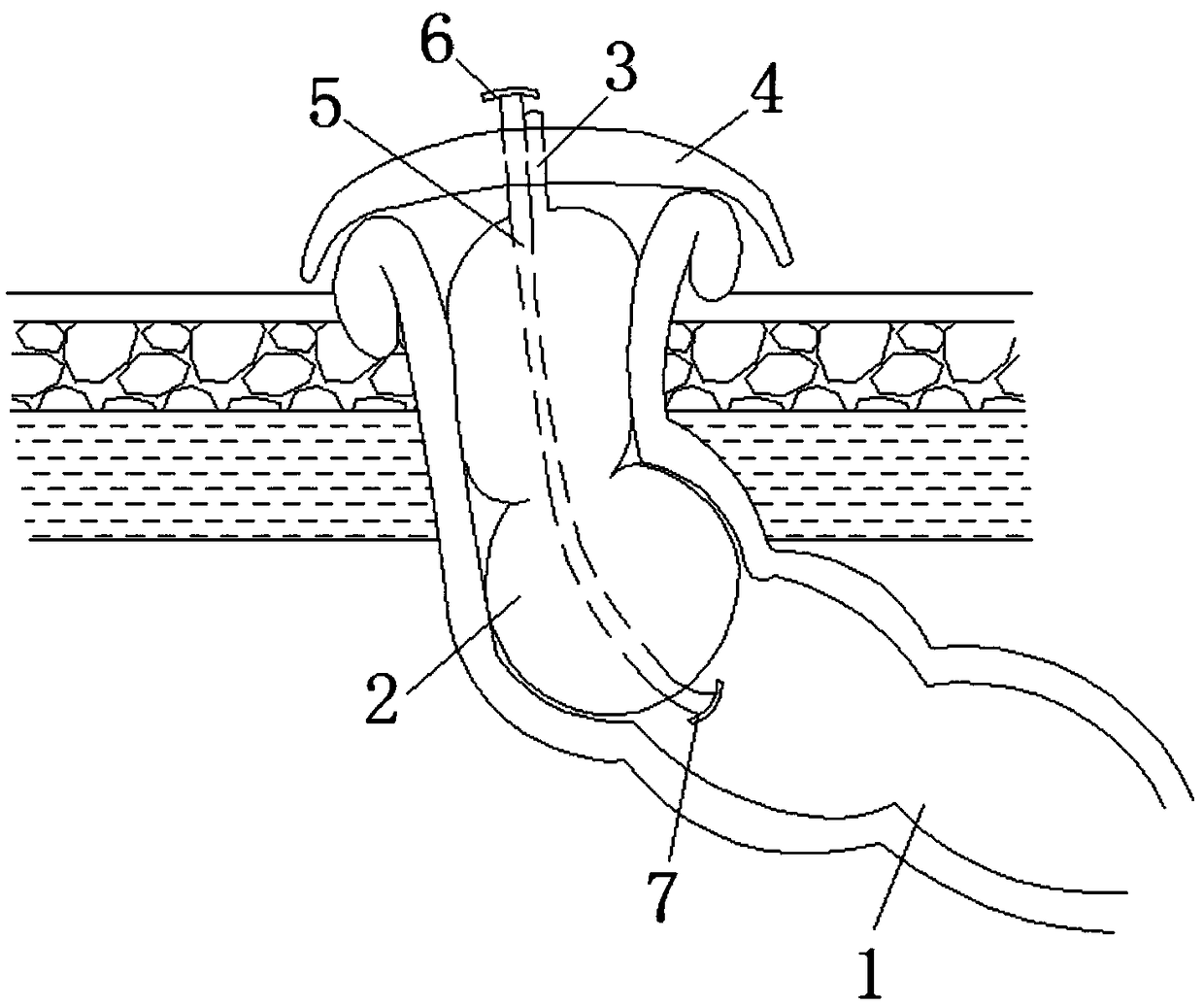 Intestinal stoma control device