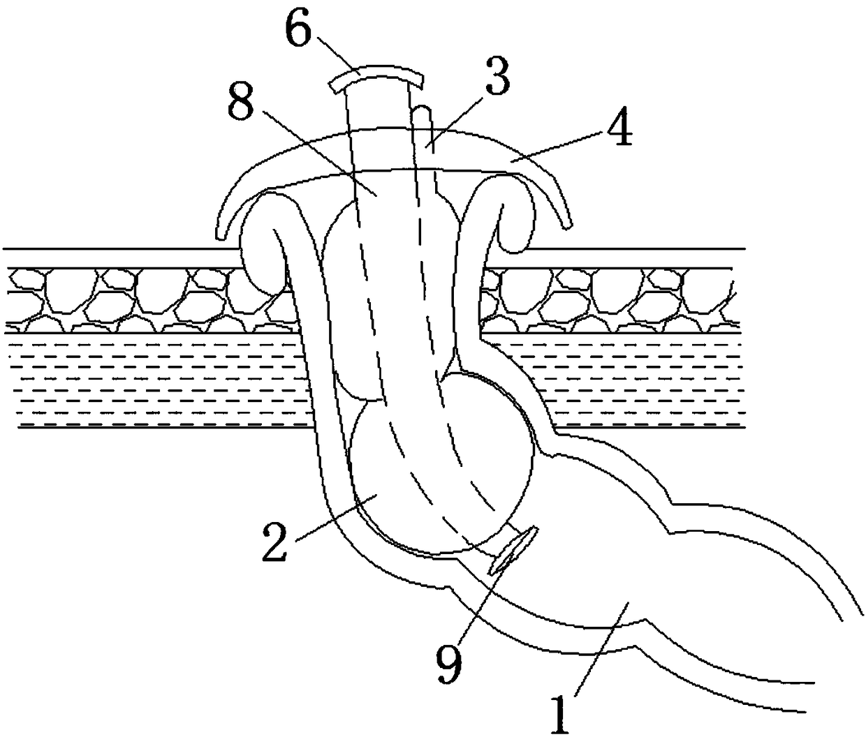 Intestinal stoma control device