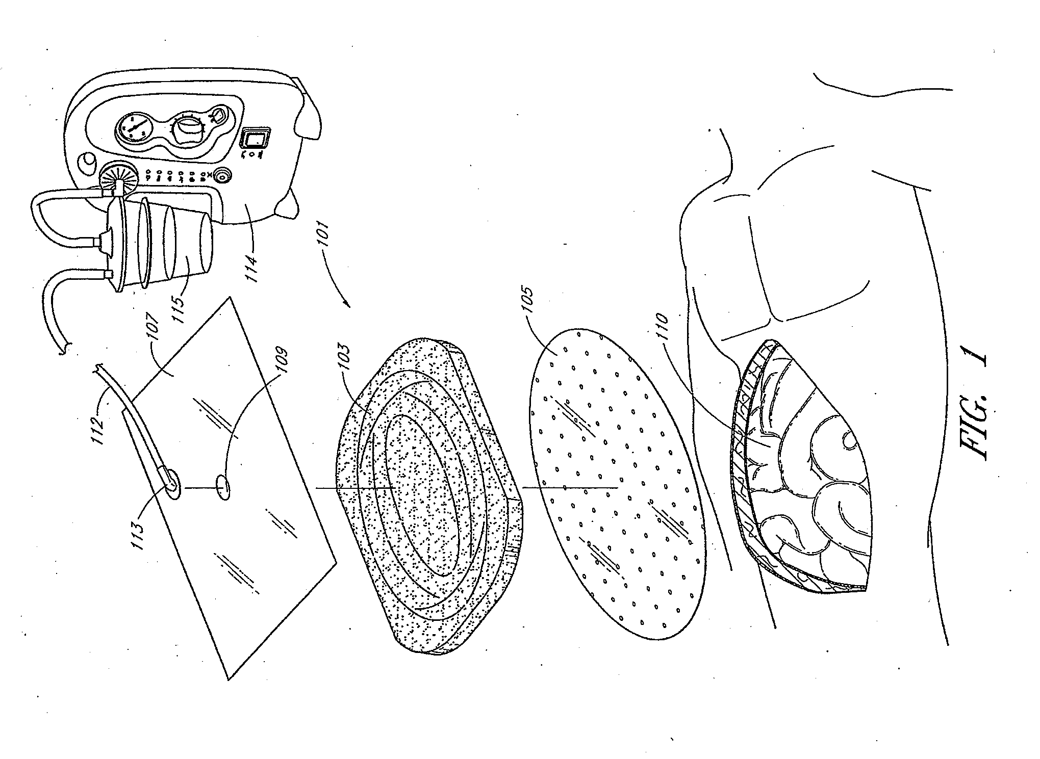 Bespoke wound treatment apparatuses and methods for use in negative pressure wound therapy