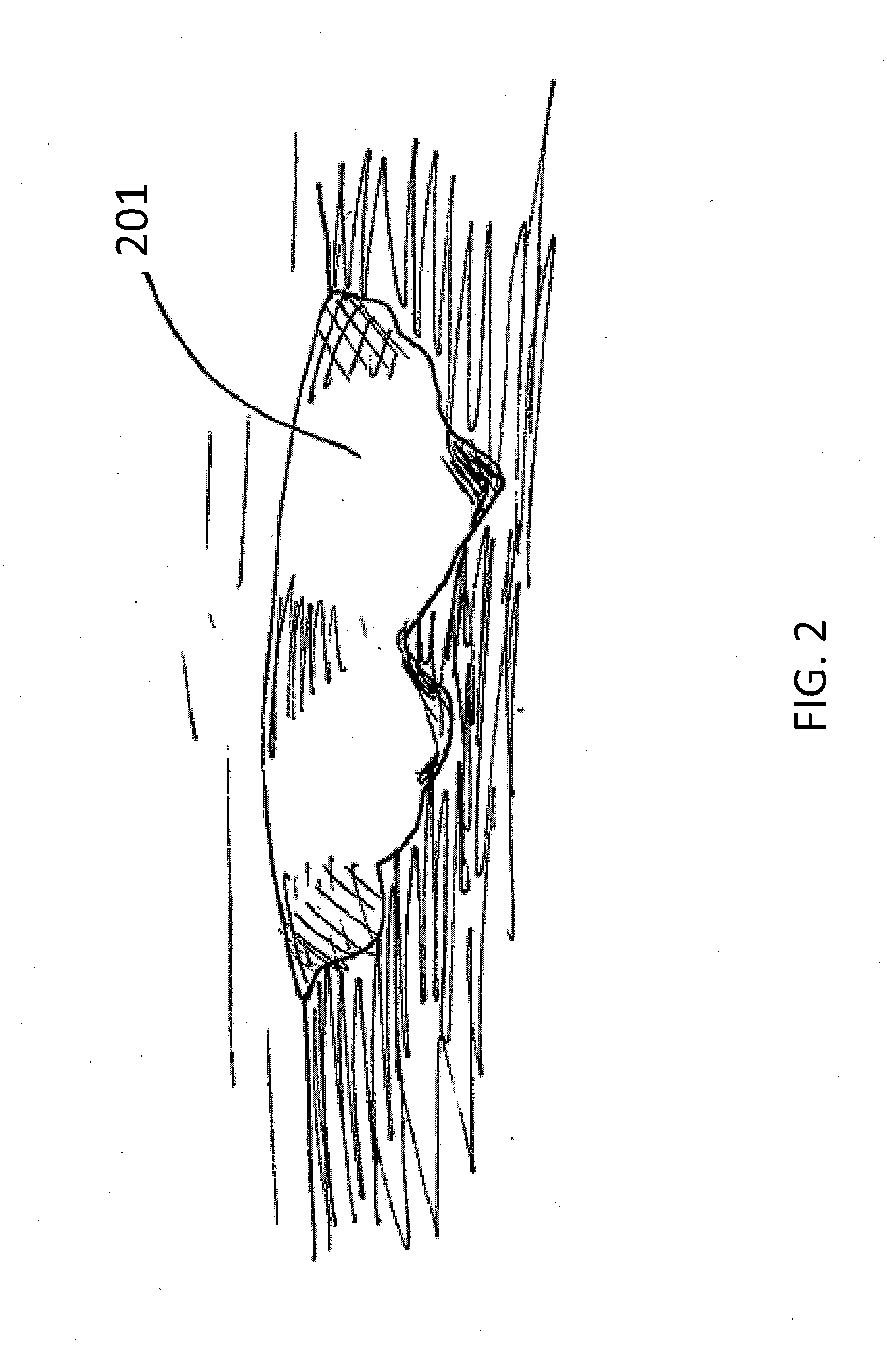 Bespoke wound treatment apparatuses and methods for use in negative pressure wound therapy