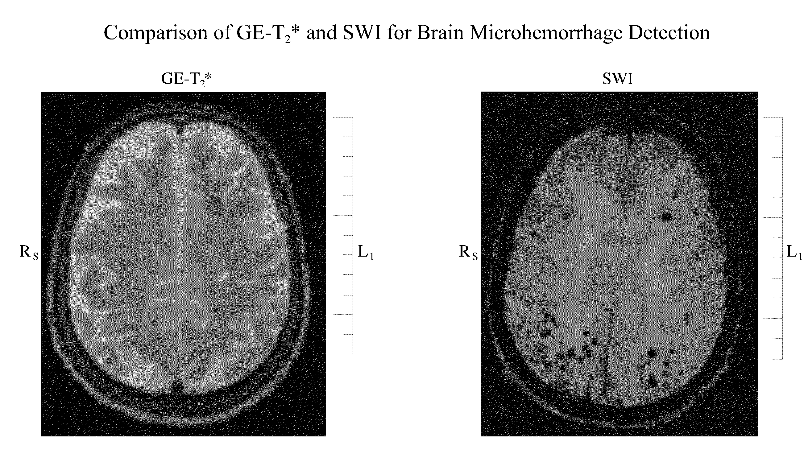 Inhibition of brain enzymes involved in cerebral amyloid angiopathy and macular degeneration