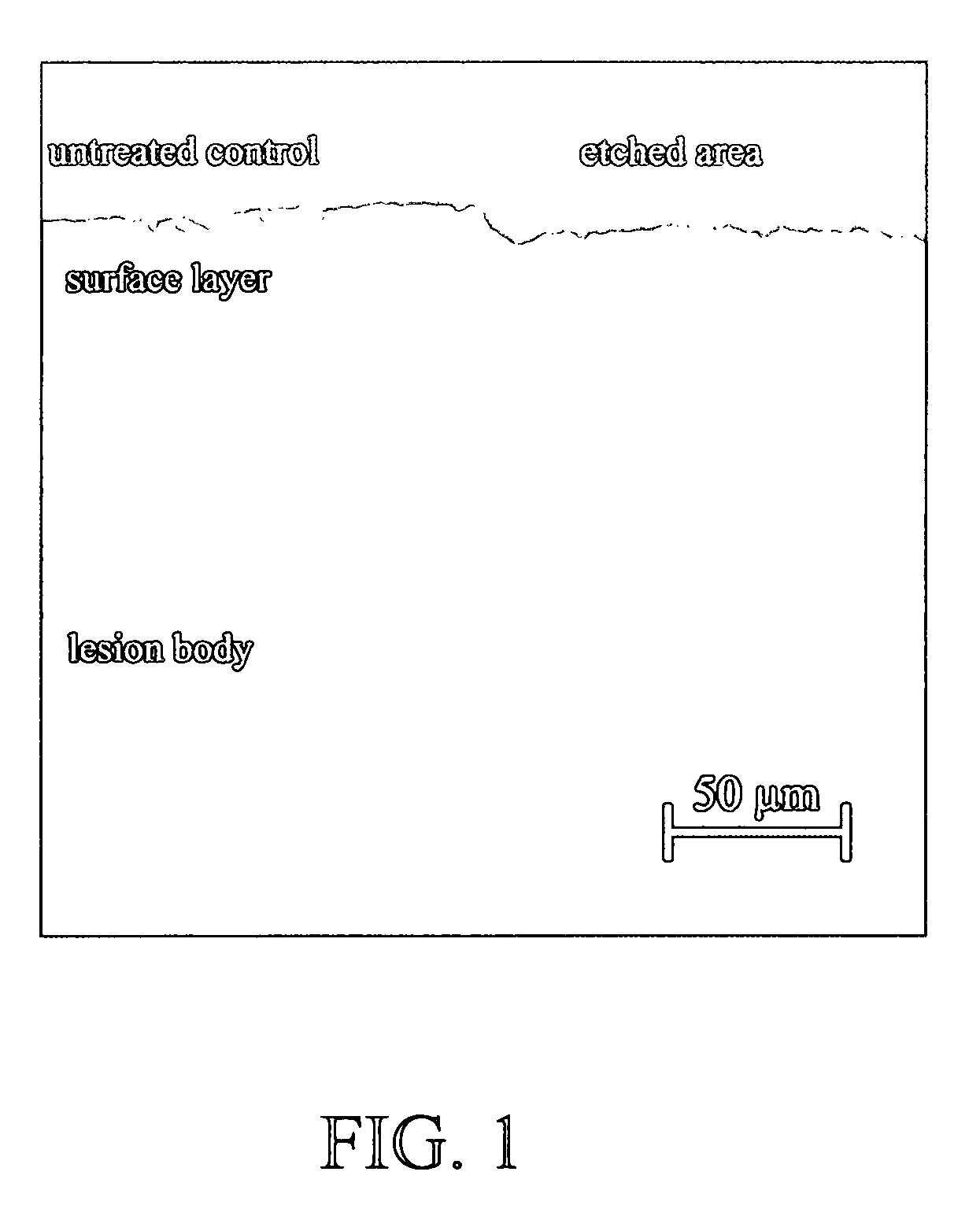 Method of infiltrating enamel lesions