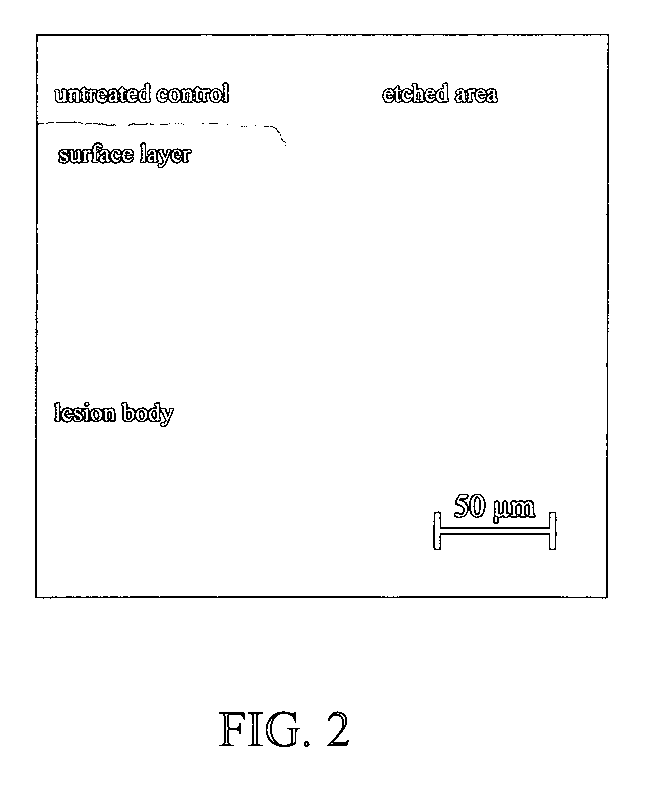 Method of infiltrating enamel lesions