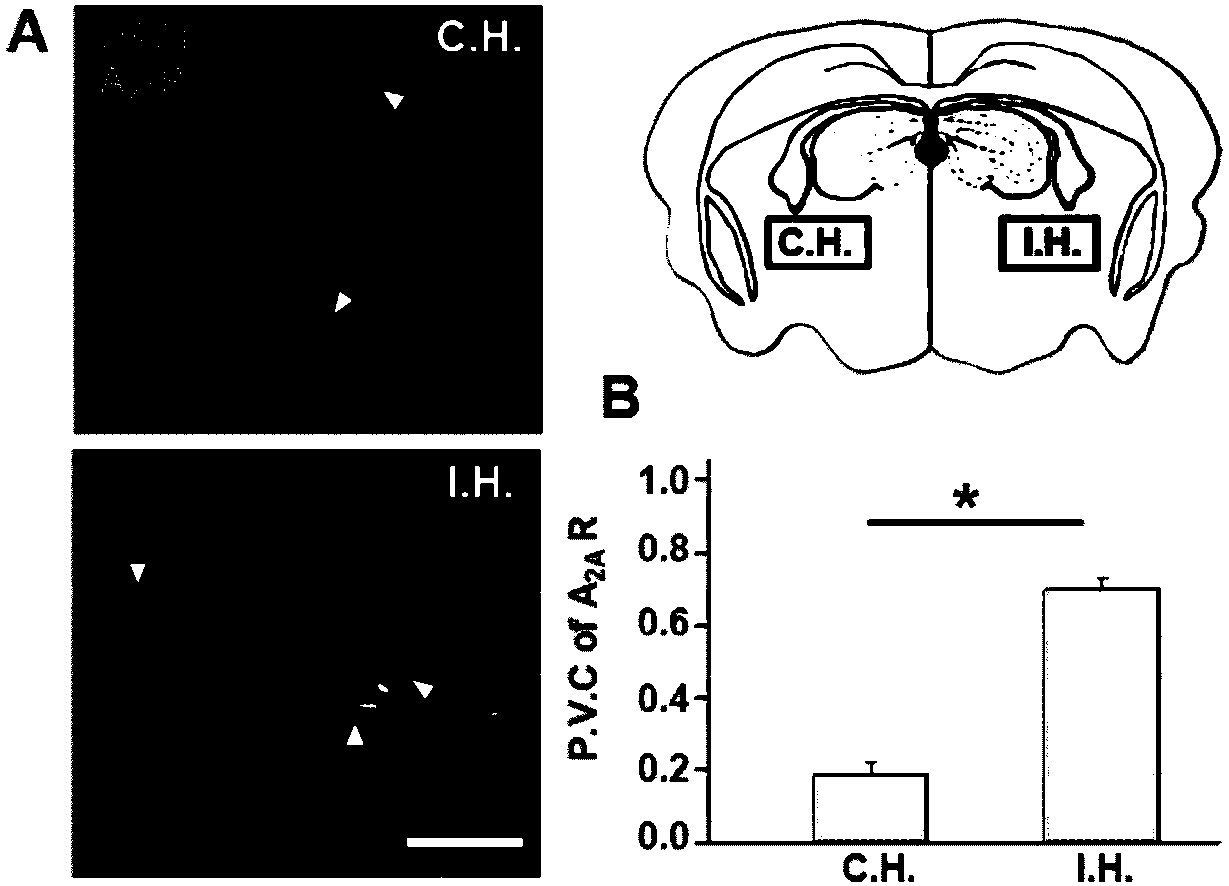 Agitation micelle for treatment of cerebral arterial thrombosis