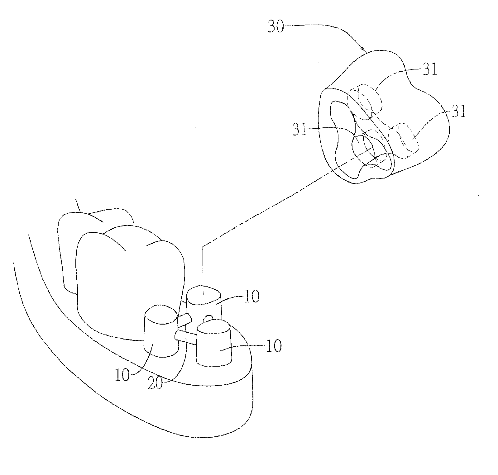 Artificial tooth with multiple internal crowns