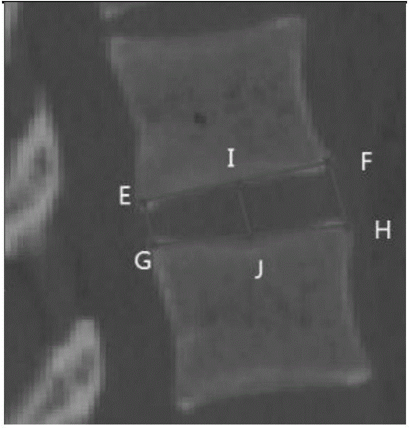 Method for designing personalized interbody fusion cage