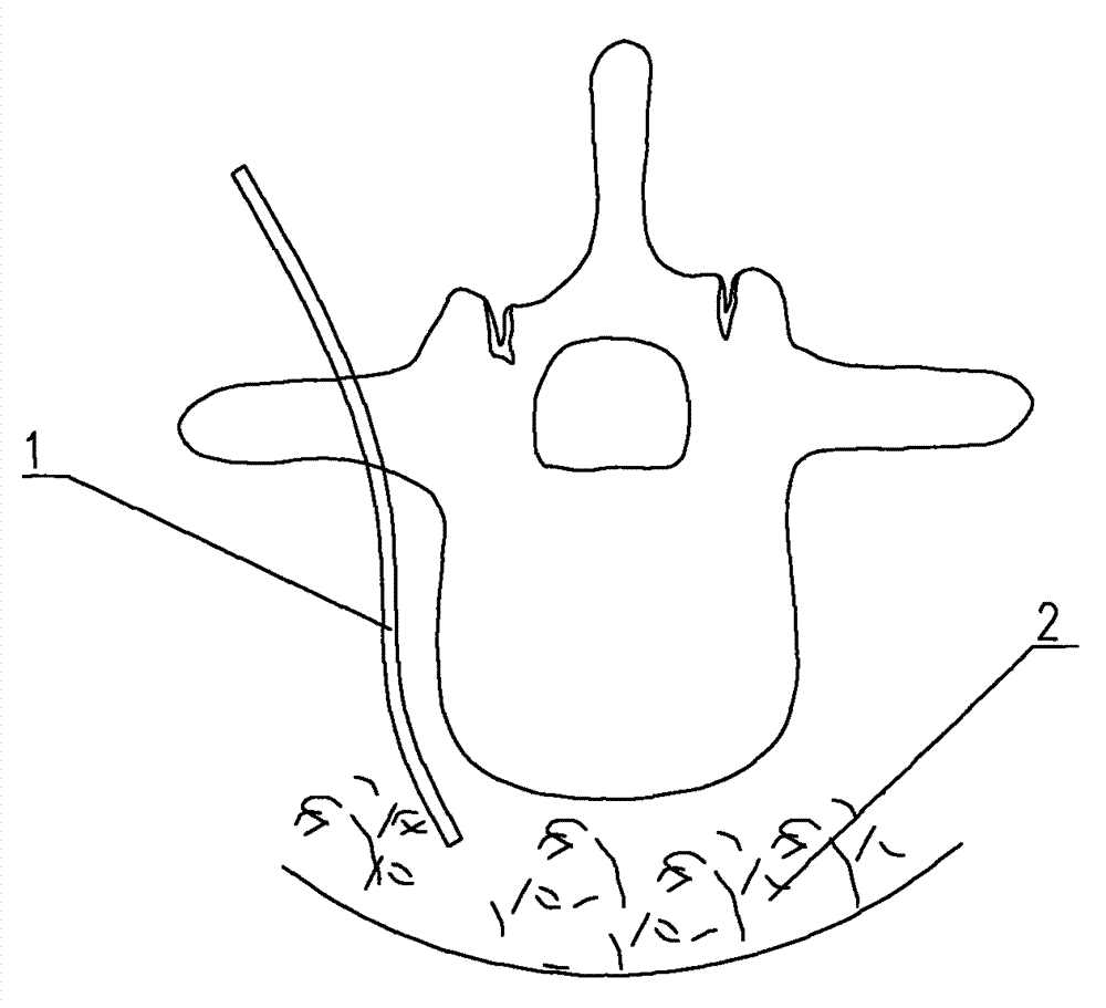 Sustainable flushing and drainage pedicle screw for treating spinal tuberculosis and screw bar system