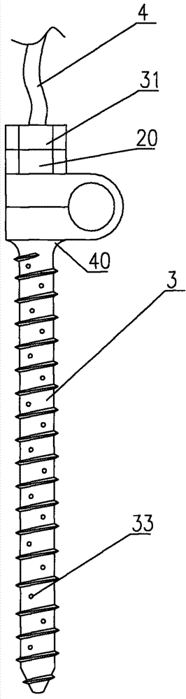 Sustainable flushing and drainage pedicle screw for treating spinal tuberculosis and screw bar system