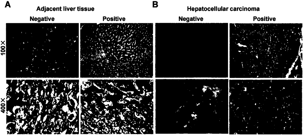 Hepatocellular carcinoma auxiliary diagnosis or disease surveillance kit and application thereof