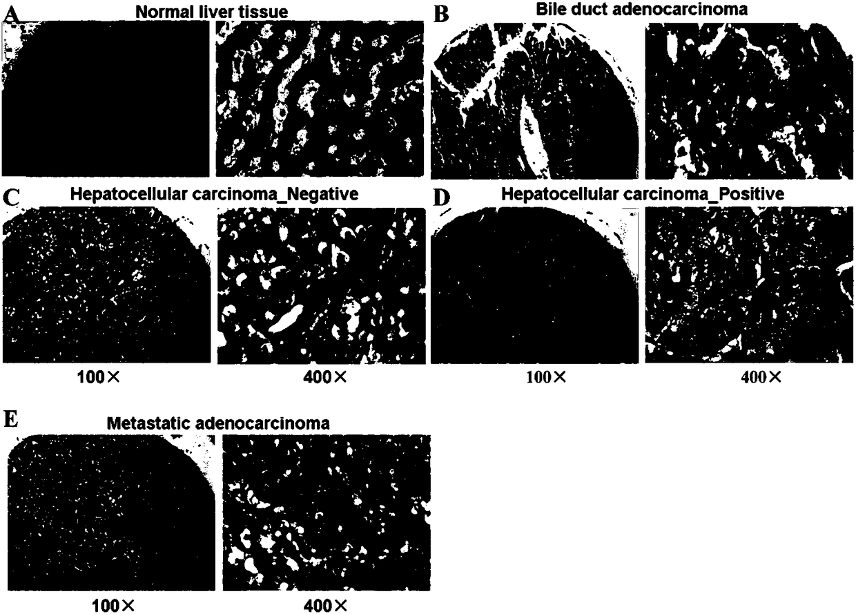 Hepatocellular carcinoma auxiliary diagnosis or disease surveillance kit and application thereof