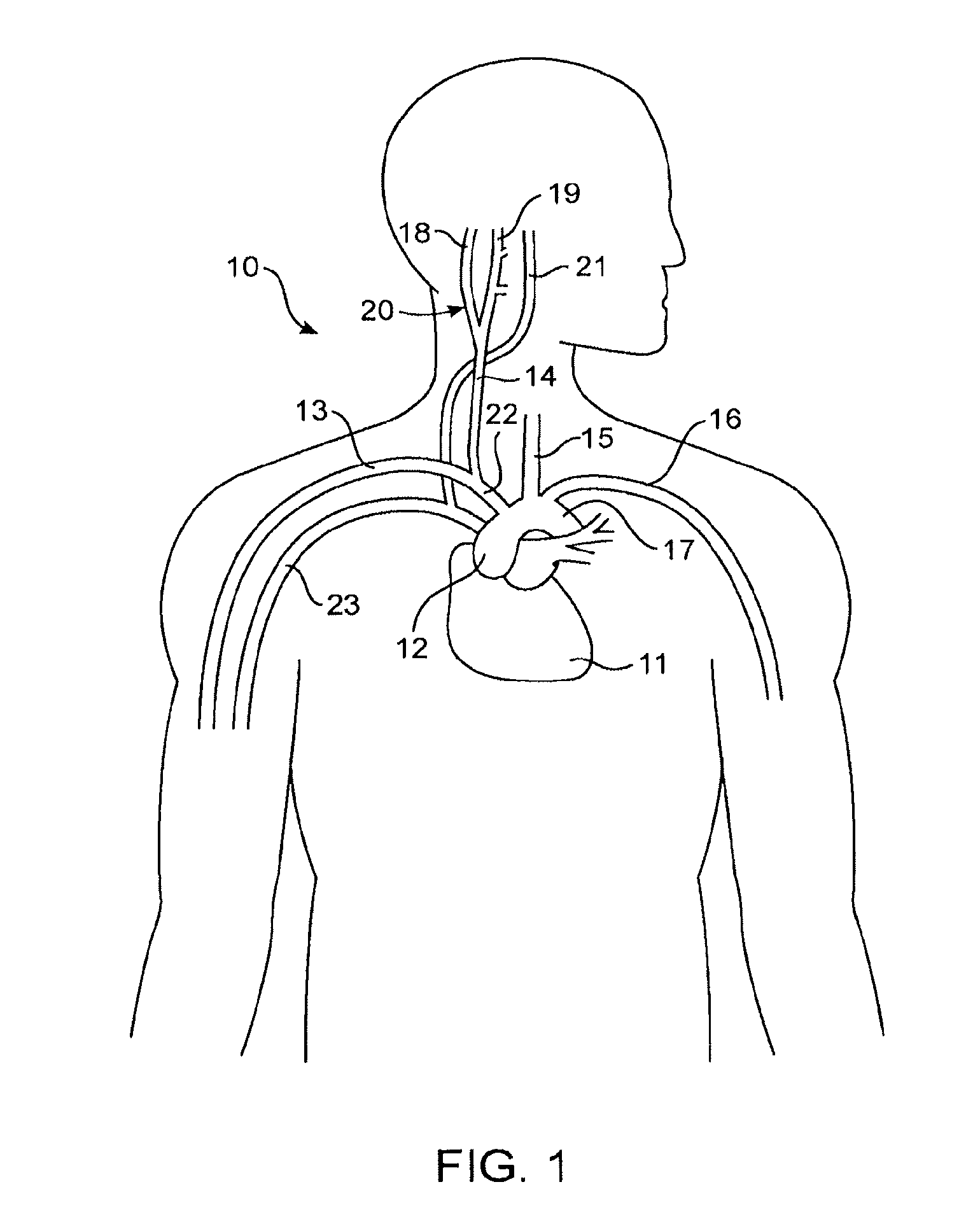 ECG input to implantable pulse generator using carotid sinus leads