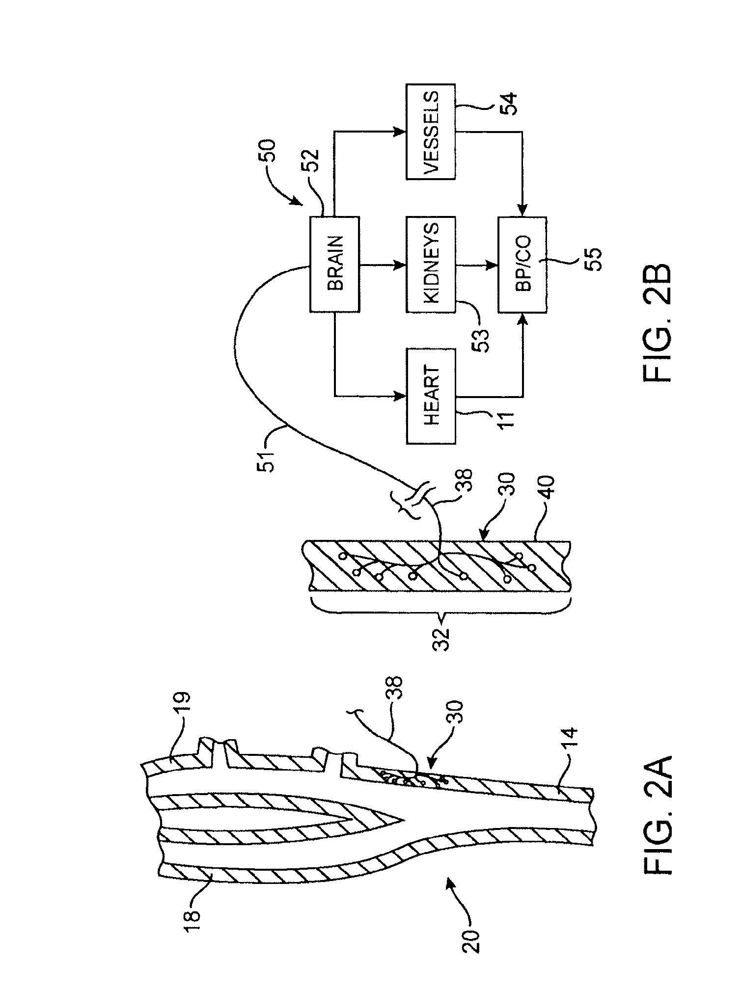 ECG input to implantable pulse generator using carotid sinus leads