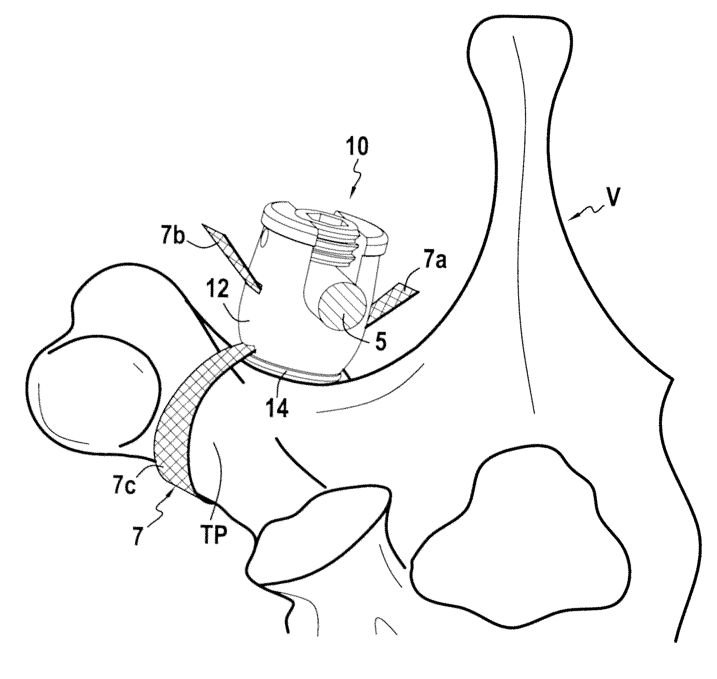 Bone fixing system