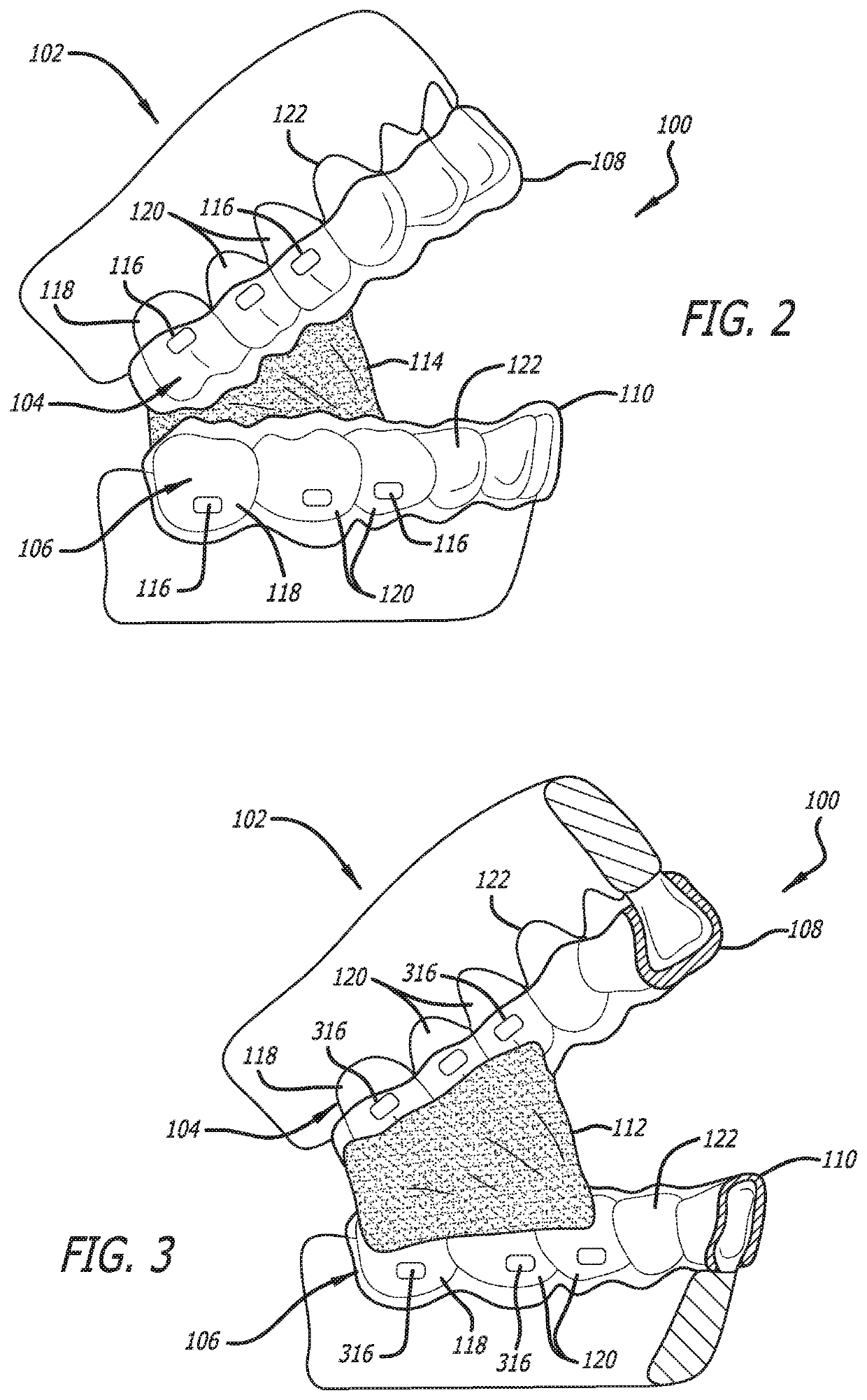 Oral weight control device