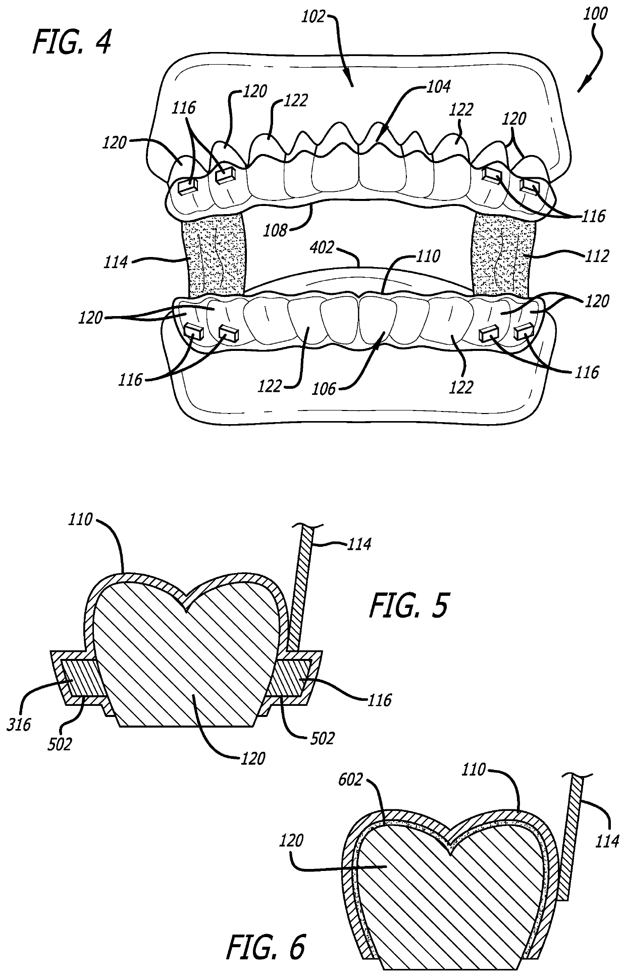 Oral weight control device