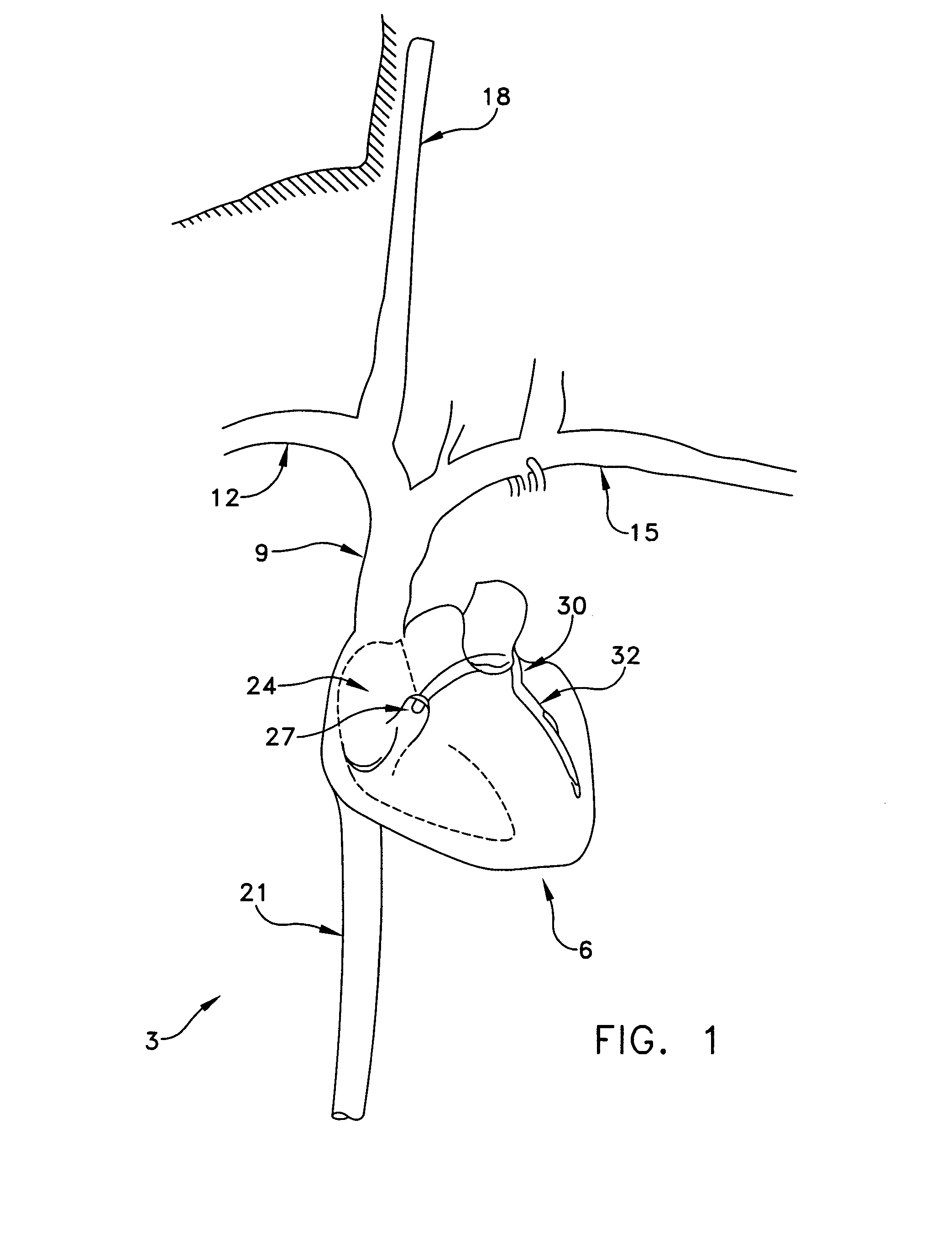 Method and apparatus for improving mitral valve function