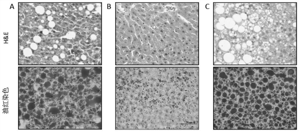 Application of cholesterol ester synthase ACAT1 inhibitor in preparation of medicine for preventing/treating non-alcoholic fatty liver disease