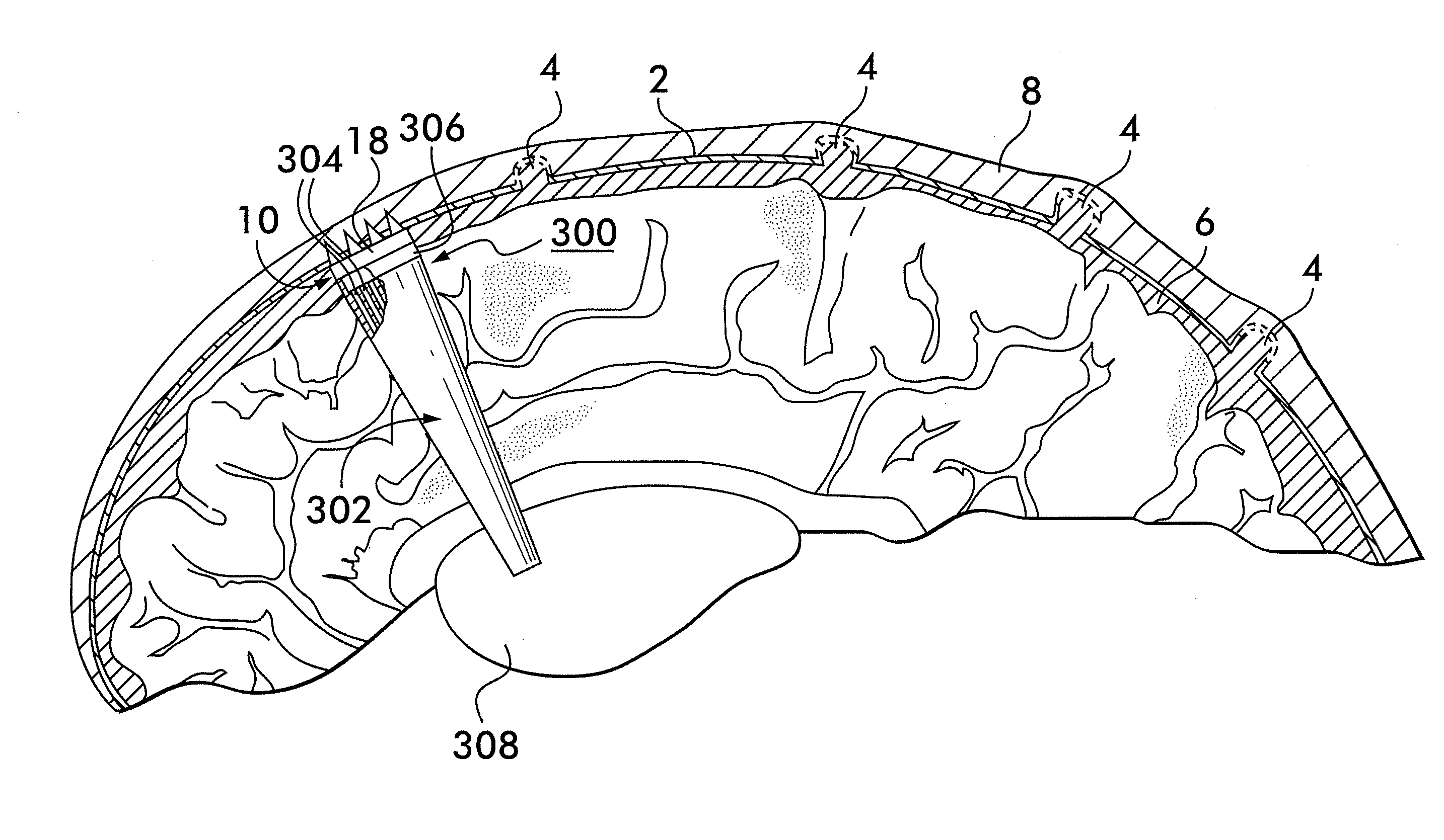 Implantable micro-system for treatment of hydrocephalus