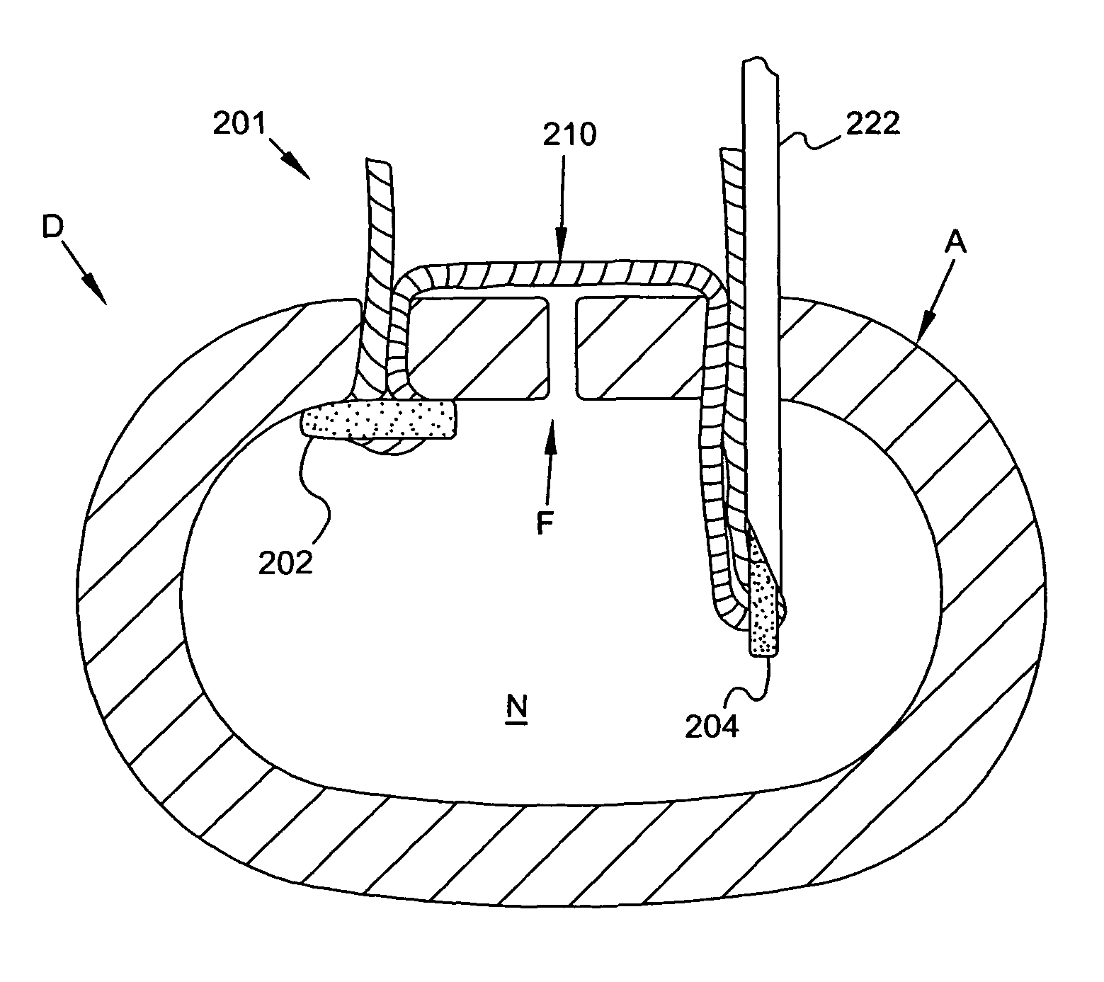 Method and apparatus for closing fissures in the annulus fibrosus