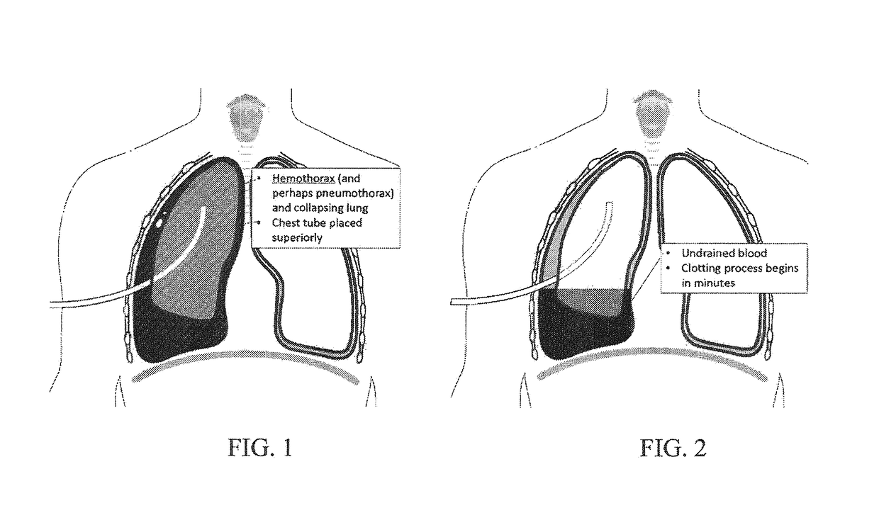 System for improving fluid drainage