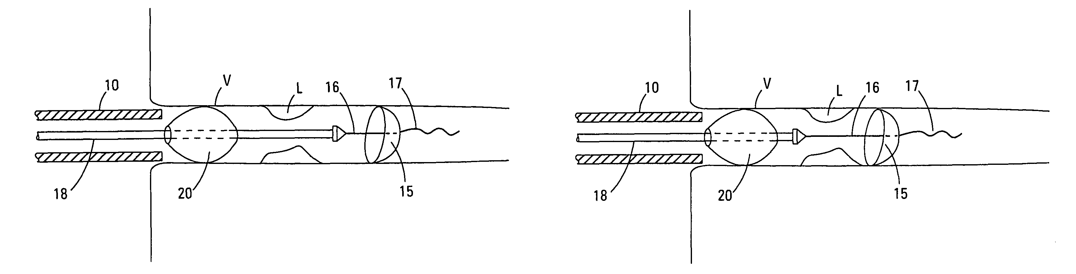 Catheter with occluding cuff