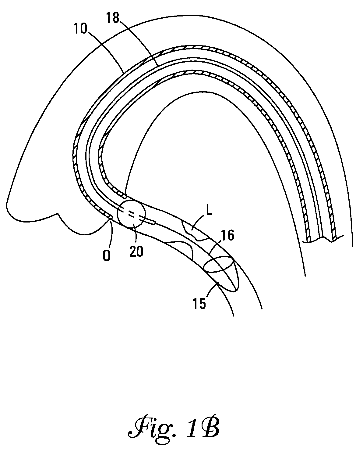 Catheter with occluding cuff