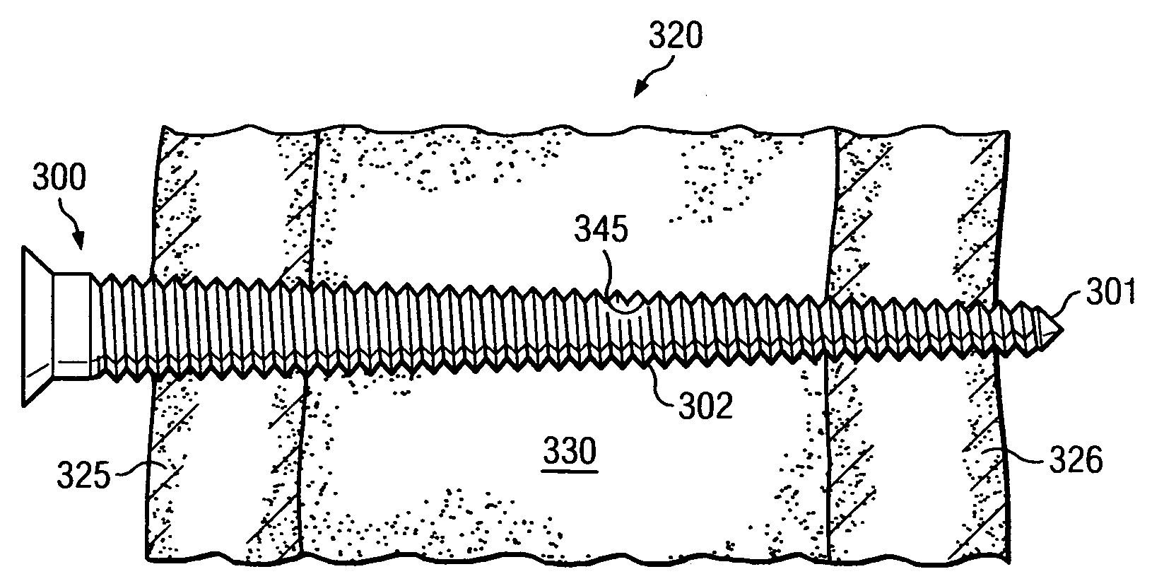 Limiting radial preloads in securing an orthopedic fastener