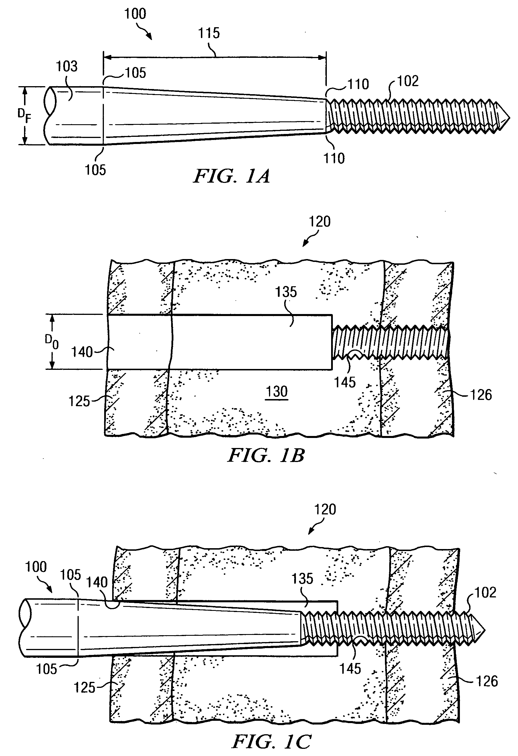 Limiting radial preloads in securing an orthopedic fastener