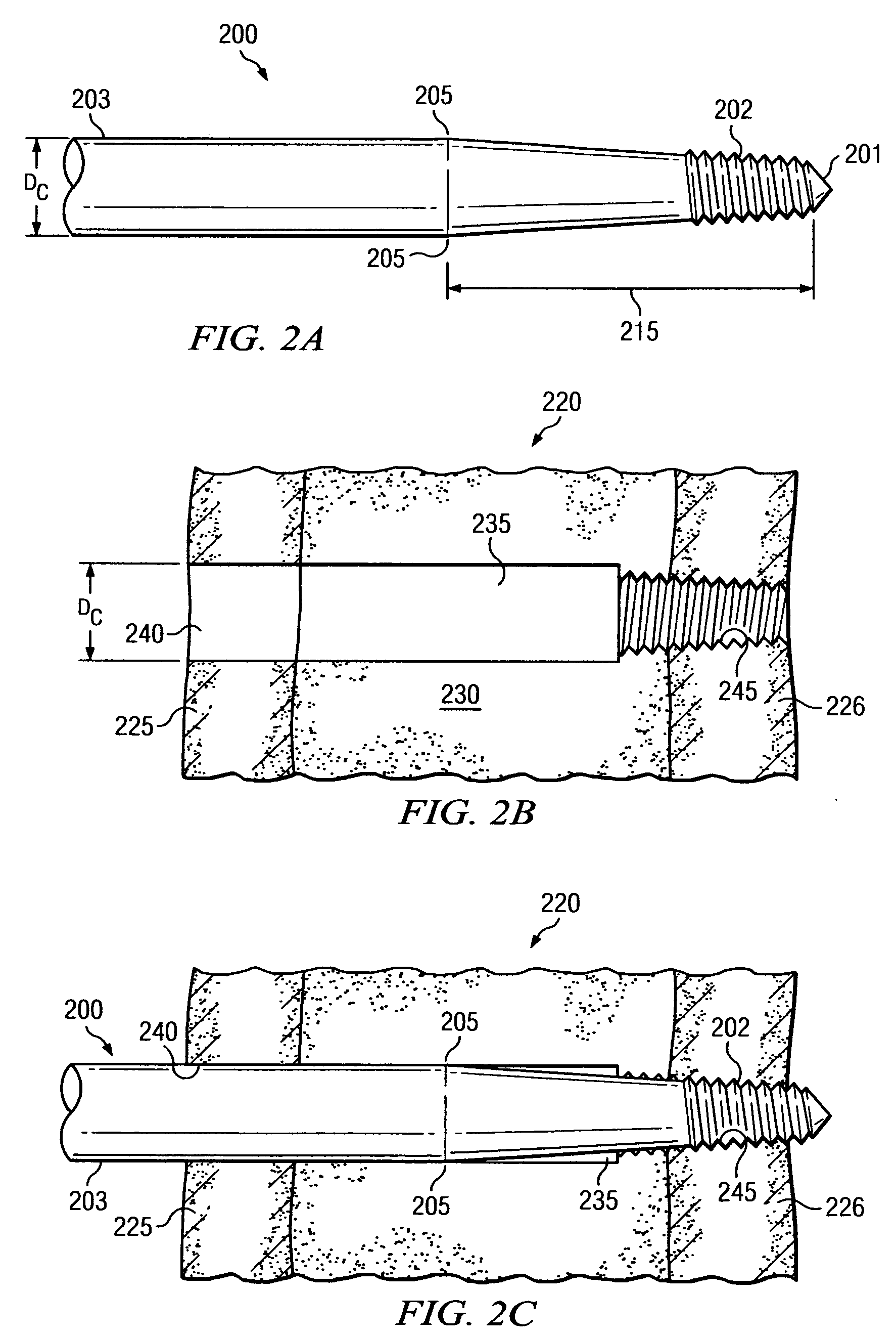 Limiting radial preloads in securing an orthopedic fastener