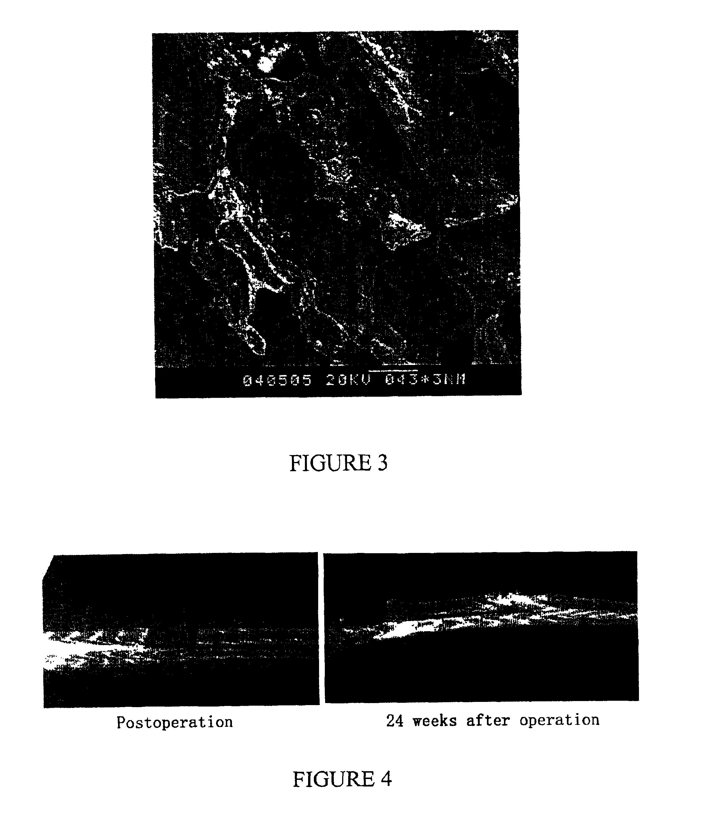 Nano-calcium phosphates/collagen based bone substitute materials