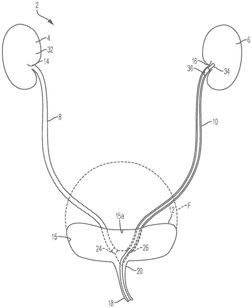 Pump assembly and system for inducing negative pressure in portion of urinary tract of patient