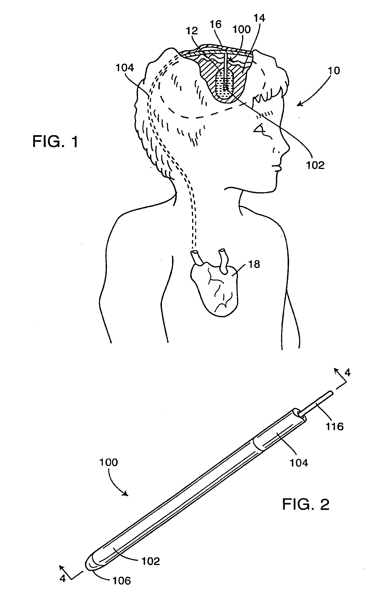 Ingrowth preventing indwelling catheter assembly