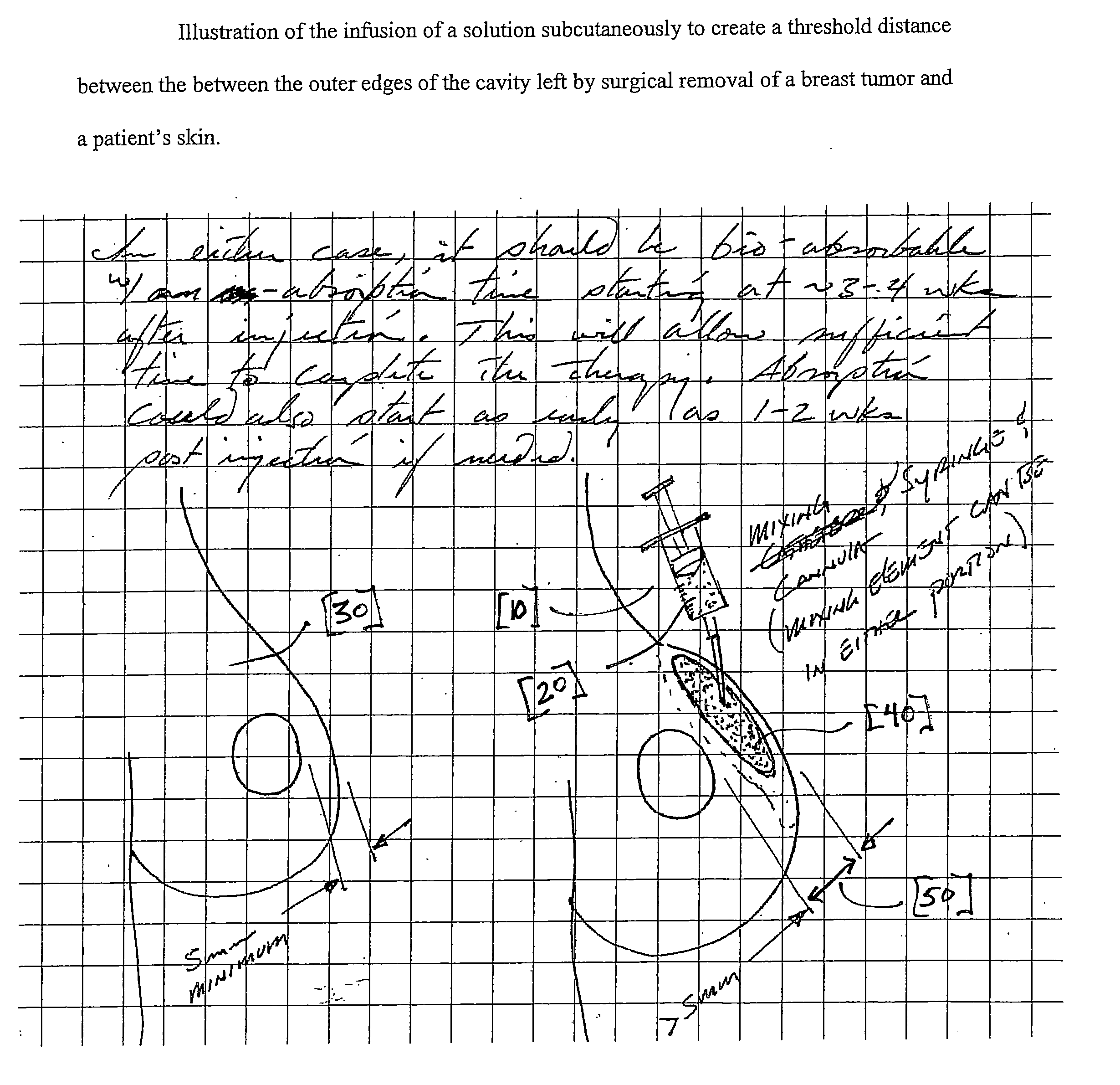 Tumescent skin spacing method